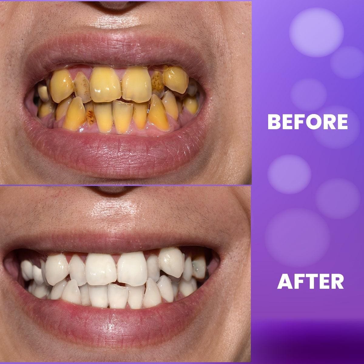 BloomBright™️ Purple Teeth Whitening Gel